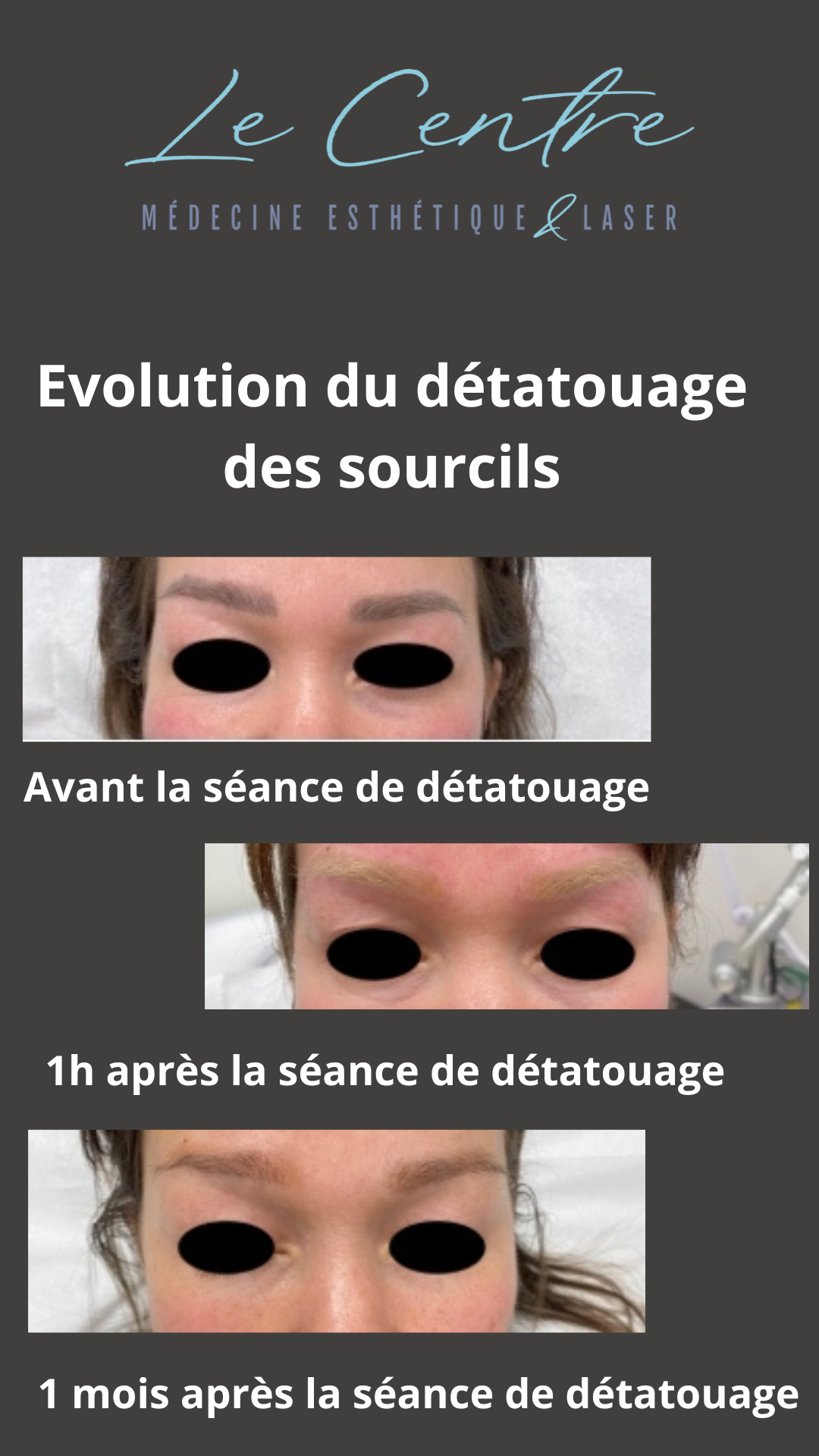 detatouage-des-sourcils-votre-story