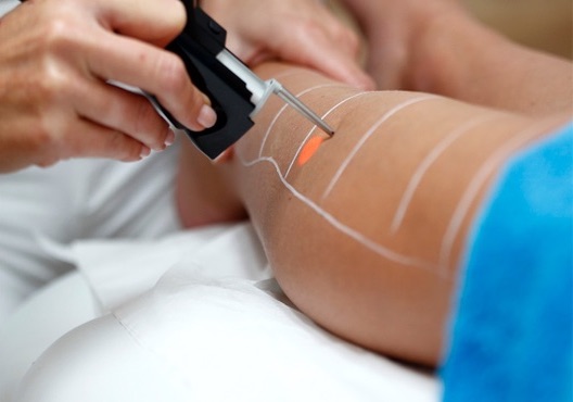 epilation-laser-jambes