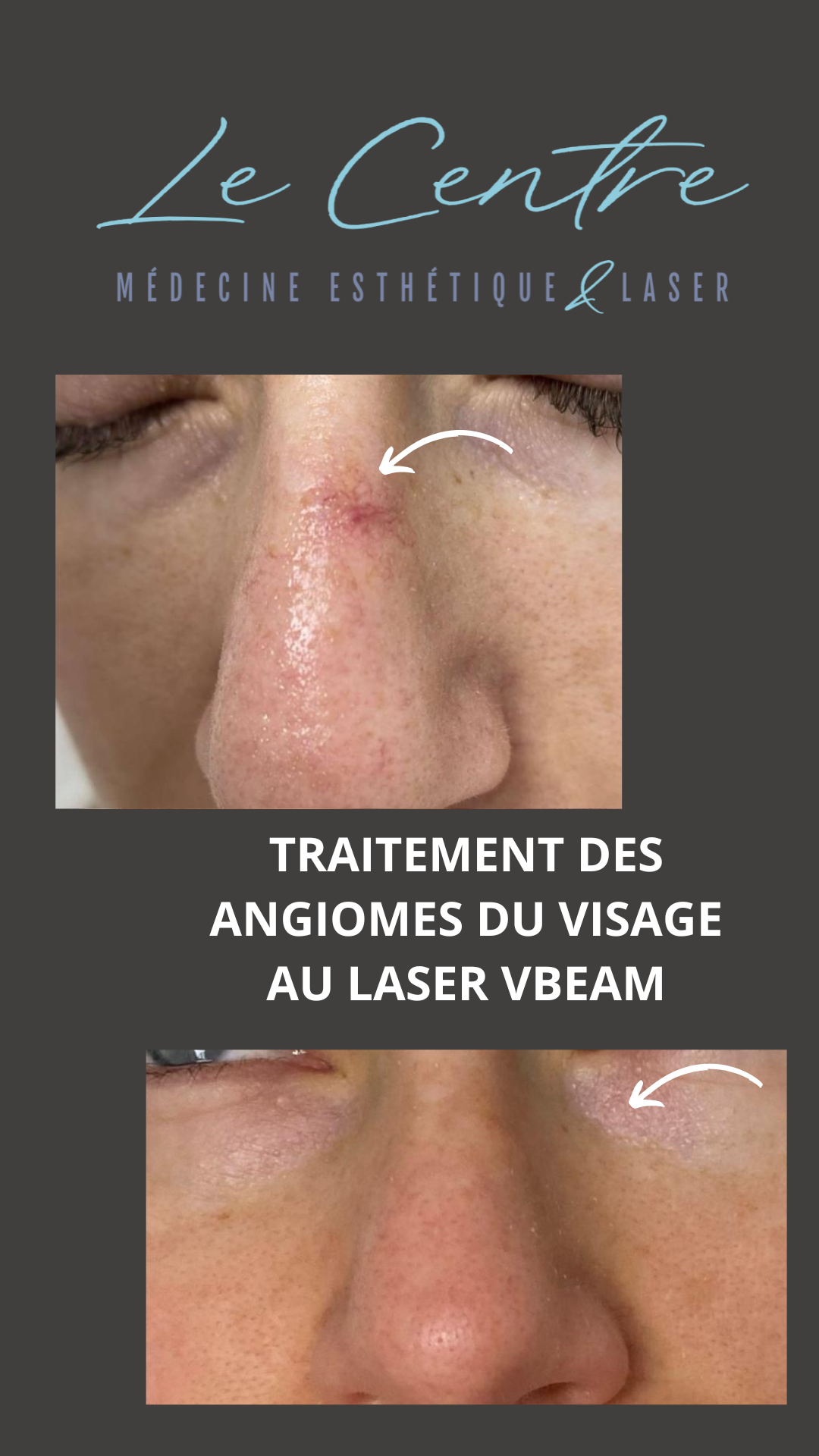 traitement-des-angiomes-votre-story